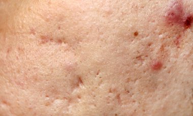 Sivilceli bir cilt sorunu. İnsan deri dokusunu en iyi kalitede stokla. Yara izli fotoğraf..