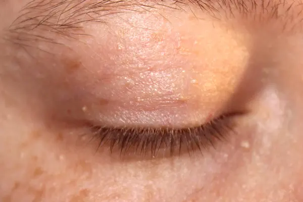 stock image Closed eye of a girl with white dots on the skin. Milia on the skin close-up.