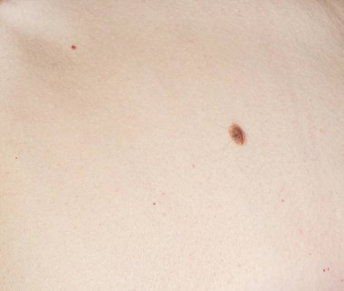 Vücudun üst kısmında bir ben var. Dermatolojik referans için açıkça ele geçirilmiş..