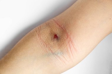 Kolundaki iğneden kaynaklanan bir çürük. Koldaki bir damardan kan testi yapın. Fotoğraf.