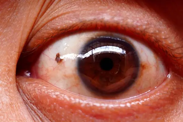 Pterygium ya da melanomdan etkilenen Asyalı bir adamın kahverengi gözlü.