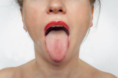 Front view of woman's face with her tongue sticking out. Treatment of ENT diseases.