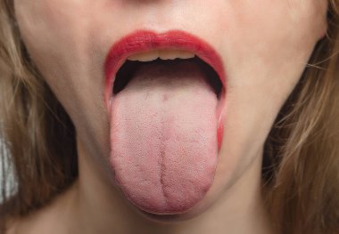 Woman's tongue close-up. Treatment of ENT diseases