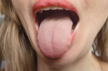 Woman's tongue close-up. Treatment of ENT diseases