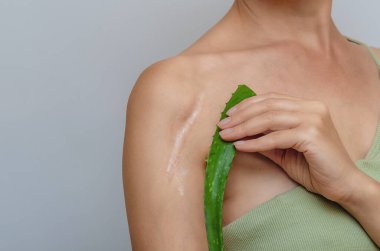 Omzunda yara izi. Aloe yaprağı, kadının omzunda ameliyat sonrası yara izi olduğunu gösteriyor. Yara iyileşme, ciltteki yaraların tedavisi..