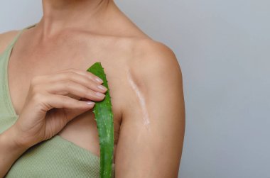 Omzunda yara izi. Aloe yaprağı, kadının omzunda ameliyat sonrası yara izi olduğunu gösteriyor. Yara iyileşme, ciltteki yaraların tedavisi..