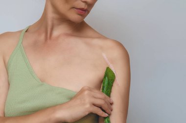 Omzunda yara izi. Aloe yaprağı, kadının omzunda ameliyat sonrası yara izi olduğunu gösteriyor. Yara iyileşme, ciltteki yaraların tedavisi..
