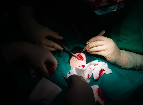 Detailní Záběr Rukou Chirurga Uzavírajícího Podkožní Tkáň Odstranění Dermatologické Léze — Stock fotografie