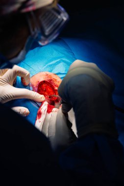 Ameliyathanede dermatolojik ameliyat. Cerrahi yaranın kan damarlarının pıhtılaşması. Squamous hücre kanseri. Bir cerrahın ve asistanının elleri bir hastanın yüzüne müdahale ediyor..