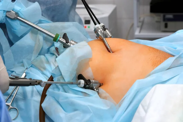 Operacja Żołądka Procedura Medyczna Leczenia Pacjenta Interwencją Chirurgiczną Sali Operacyjnej — Zdjęcie stockowe