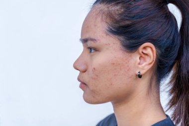 Yüzünde deri sorunu olduğunda genç Asyalı kadınların yüzleri için endişelen. Sivilcelerle ve kadın derisinde yara izleri var. Sorunlu cilt bakımı ve sağlık konsepti.