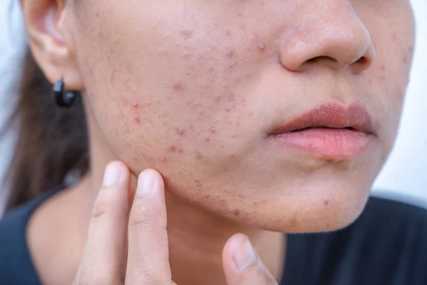 Close up of young Asian woman worry about her face when she has problems with skin on her face. Problems with acne and scar on the female skin. Problem skincare and health concept.