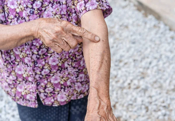 Senior\'s fingers points to  wrinkled hand. Aging process - very old senior woman\'s hands wrinkled skin, effect of age on the skin, old age. wrinkled skin and prominent veins. elderly woman\'s hands