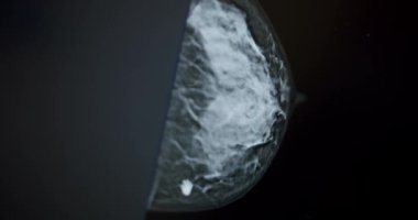 Breast scan on computer monitor. Closeup handheld shot of mammogram of breast on computer monitor during cancer examination in laboratory of modern clinic. Diagnosis of breast cancer.