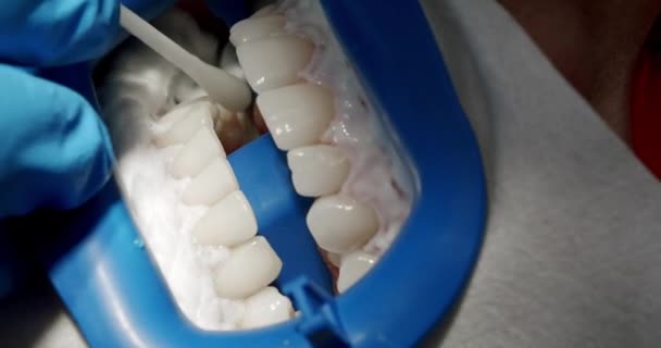 口腔衛生と予防的洗浄を閉じます 歯科での衛生歯の洗浄手順で女性患者 歯の洗浄 歯科現代クリニックで患者のための歯の洗浄を作る歯科医 — ストック動画