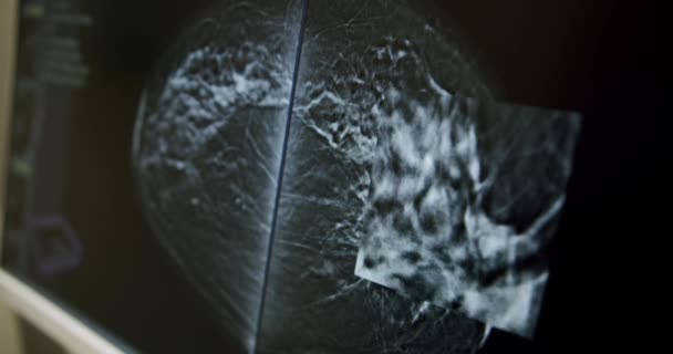 Zbliżenie Handheld Strzał Mammogram Piersi Monitorze Komputera Podczas Badania Raka — Wideo stockowe