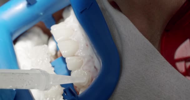 Zahnarzt Macht Zahnreinigung Für Den Patienten Der Modernen Zahnklinik Mundhygiene — Stockvideo