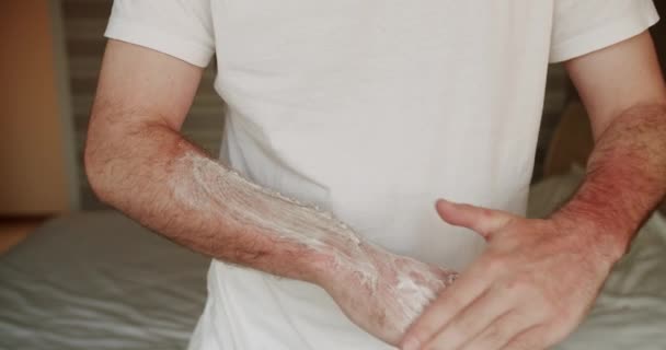 Άνθρωπος Εφαρμόζει Μια Θεραπευτική Κρέμα Ένα Ηλιακό Έγκαυμα Στο Δέρμα — Αρχείο Βίντεο