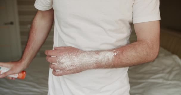 Man Applicerar Terapeutisk Kräm Solbränna Huden Handen Applicera Solkräm Röd — Stockvideo