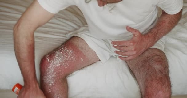 Mężczyzna Nakłada Krem Terapeutyczny Oparzenia Słoneczne Skórę Nogi Stosowanie Kremu — Wideo stockowe
