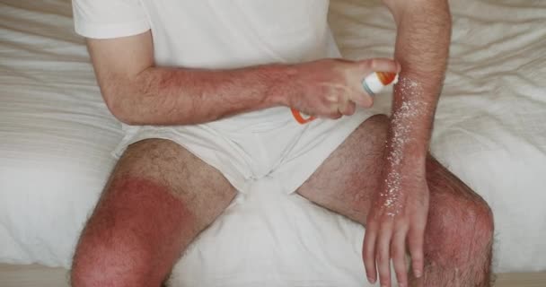 Applicera Solkräm Röd Solbränd Hud Applicera Solskyddsmedel Speciell Terapeutisk Kräm — Stockvideo