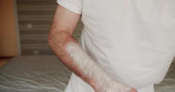 Чоловік Наносить Лікувальний Крем Опік Сонця Шкіру Руки Нанесення Сонцезахисного — стокове відео