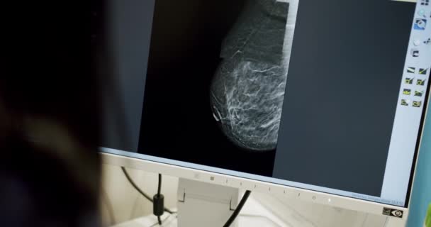 Arzt Untersucht Mammographie Der Weiblichen Brust Auf Computerbildschirm Der Klinik — Stockvideo