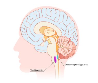 Mide bulantısı ve kusma mekanizmaları itici duyulardan kaynaklanır. Kusma bölgeleri ve duyuları olan beyin çizimi