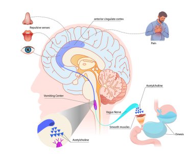 Kusma merkezi ve kemoterapi alan anatomisini tetikliyor. CTZ ve VC bölgelerinin topoğrafyasına sahip bir beynin şematik çizimi