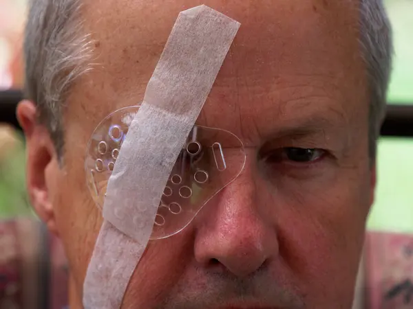 A transparent eye shield is taped over a man\'s eye to protect it while it heals from IOL surgery.