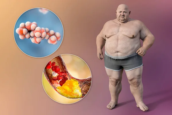 Παχυσαρκία Και Αθηροσκλήρωση Απεικόνιση Δείχνει Ένα Παχύσαρκο Πρόσωπο Μόριο Χοληστερόλης — Φωτογραφία Αρχείου
