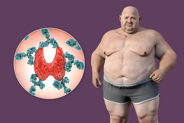 自己免疫甲状腺疾患と肥満との関連 抗体によって攻撃された太りすぎの患者と甲状腺を示す概念的な3Dイラスト — ストック写真