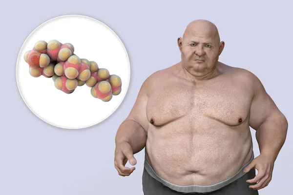 Obesity Dyslipidemia Conceptual Illustration Showing Cholesterol Molecule Overweight Person Metabolic — Φωτογραφία Αρχείου