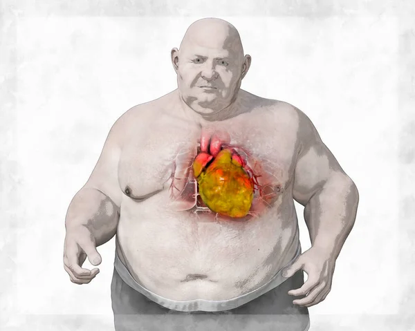 Obese heart in overweight man, 3D illustration. Concept of obesity and inner organs disease. Heart obesity with increased risk of cardiovascular disease, heart failure, and coronary heart disease
