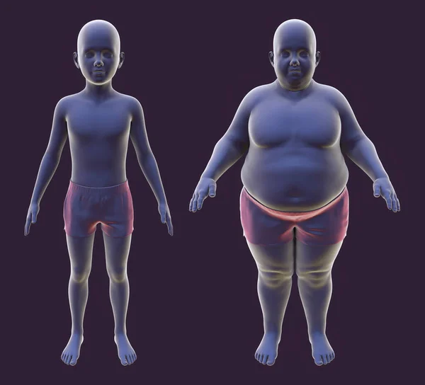 Obese boy before and after gaining weight, 3D illustration. Concept of obesity, behavioral problem, psychiatric condition, binge eating disorder, food addiction