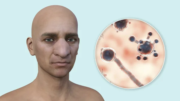 Rhinofacial conidiobolomycosis in a man and Conidiobolus coronatus microscopic fungi, 3D illustration. Tropical fungus, causes polyps or under skin masses in nasal cavity