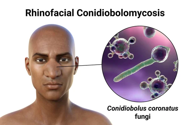 Rhinofacial conidiobolomycosis in a man and Conidiobolus coronatus microscopic fungi, 3D illustration. Tropical fungus, causes polyps or under skin masses in nasal cavity