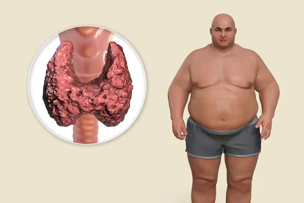 Association between autoimmune thyroid disease and obesity, conceptual 3D illustration showing an overweight patient and thyroid gland attacked by antibodies