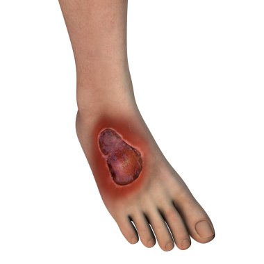 Buruli ulcer, a chronic debilitating disease affecting skin and subcutaneous tissues found mainly in tropical and subtropical countries caused by bacteria Mycobacterium ulcerans, 3D illustration