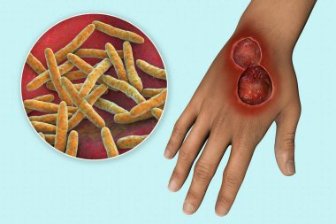Buruli ulcer, a chronic debilitating disease affecting skin and subcutaneous tissues found mainly in tropical and subtropical countries caused by bacteria Mycobacterium ulcerans, 3D illustration