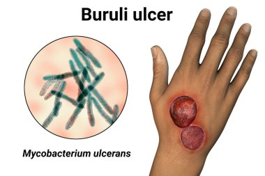Buruli ulcer, a chronic debilitating disease affecting skin and subcutaneous tissues found mainly in tropical and subtropical countries caused by bacteria Mycobacterium ulcerans, 3D illustration