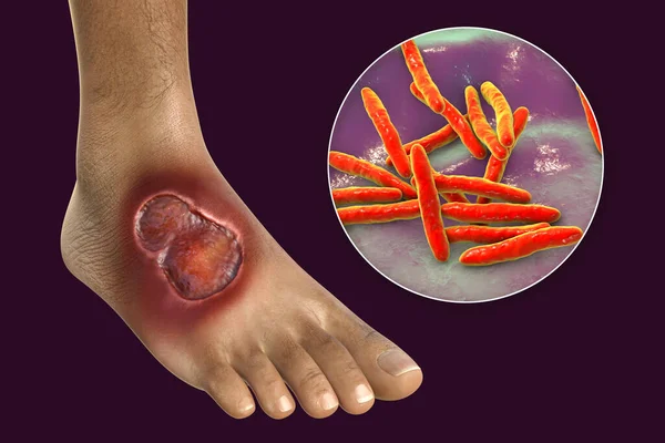 Buruli ulcer, a chronic debilitating disease affecting skin and subcutaneous tissues found mainly in tropical and subtropical countries caused by bacteria Mycobacterium ulcerans, 3D illustration