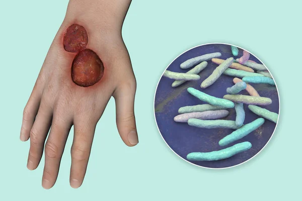 Buruli ulcer, a chronic debilitating disease affecting skin and subcutaneous tissues found mainly in tropical and subtropical countries caused by bacteria Mycobacterium ulcerans, 3D illustration