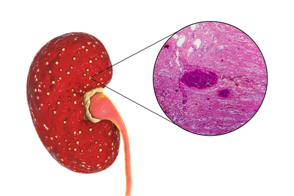 Acute Pyelonephritis Illustration Showing Gross Morphology Focal Small Abscesses Kidney — стоковое фото