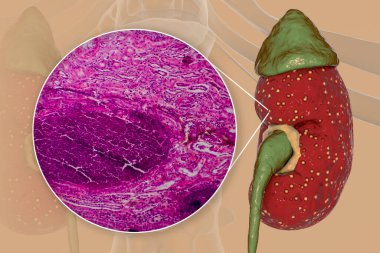 Acute pyelonephritis, 3D illustration showing gross morphology with focal small abscesses in kidney tissue and light micrograph showing histopathology of microabscesses