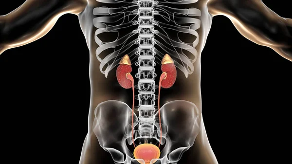 Acute Pyelonephritis Medical Concept Illustration Showing Focal Small Abscesses Kidney — Stockfoto