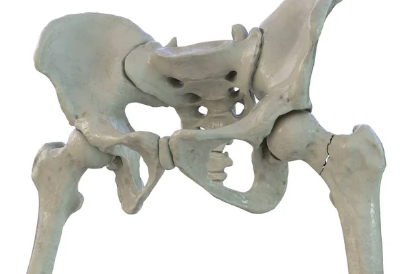 대퇴골 골절은 일반적으로 나이든 성인들에게 나타나는 고관절 골절의 일종으로 이동성 — 스톡 사진