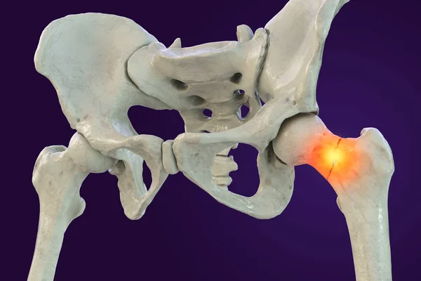 典型的には高齢者で発生し モビリティの問題や他の合併症につながる可能性が股関節の一般的なタイプである大腿骨首の骨折 白の背景に分離 3Dイラスト — ストック写真