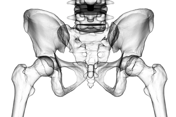 Femurknochen Betroffen Von Legg Calve Perthes Krankheit Einer Kindlichen Hüftstörung — Stockfoto