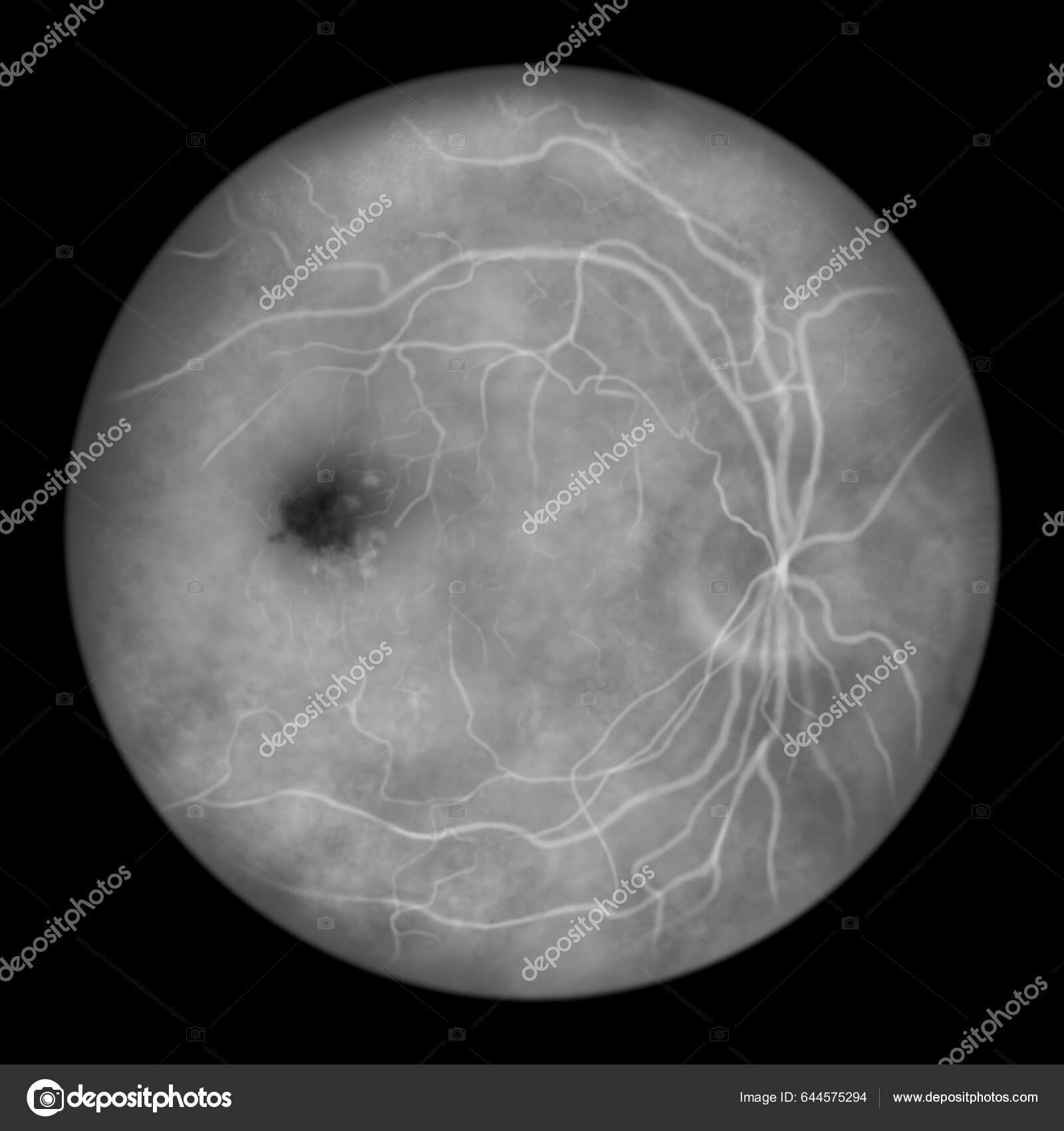 diabetic macular edema fluorescein angiography